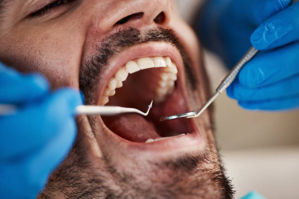 Best Emergency Dentist for Lost Fillings or Crowns in Moosic, PA